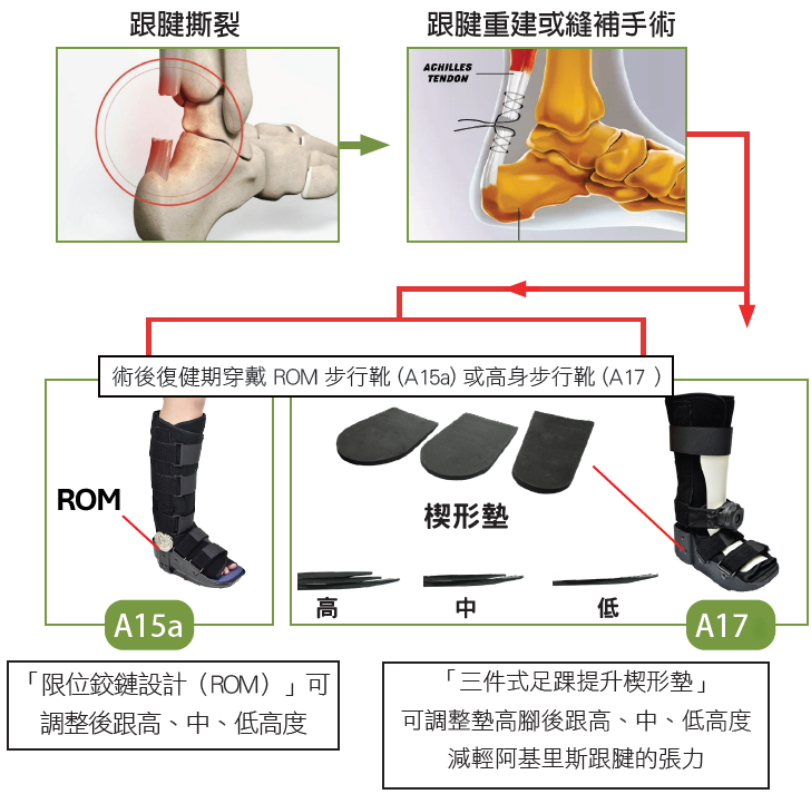 阿基里斯跟腱